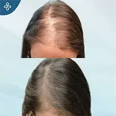 DHI Female Hair Transplant Turkey Before and After