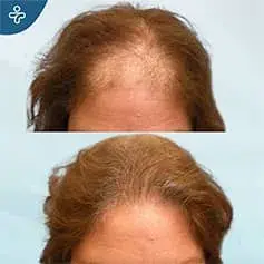 Female hairline transplant before and after