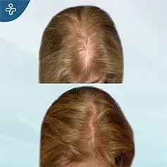 Mini Hair Transplant