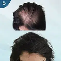 Hair implants before and after women