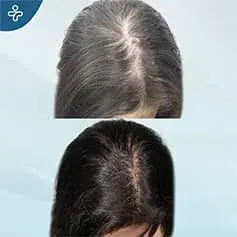 DHI Transplant Before and After