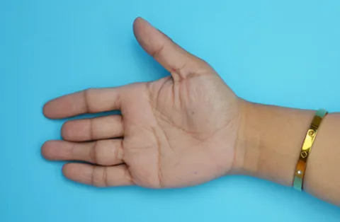 Fingerreplantationschirurgie