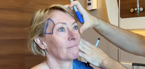 Woman in Turkey during pre-op marking for forehead contouring surgery, planning facial enhancement and symmetry