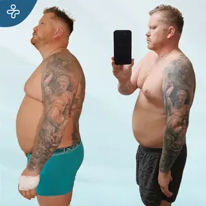 Gastric Sleeve Before and After Skin