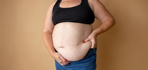 Plus-size woman pinching abdominal skin—visual context for gastric band removal surgery and weight-loss revision.