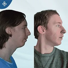 genioplasty-3