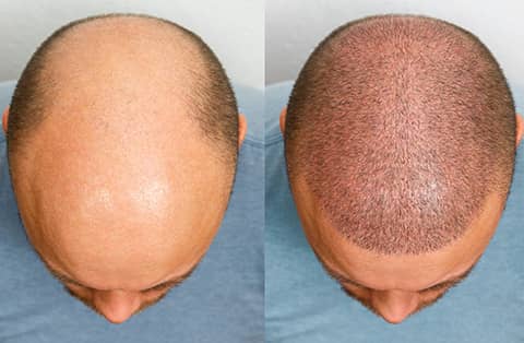 Hair Loss Before After