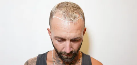 Male patient showing marked hairline design before hair transplant procedure