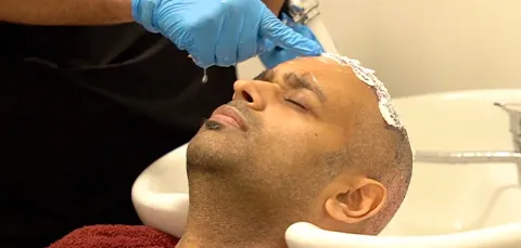 Man receiving gentle post-op washing after hair transplant procedure