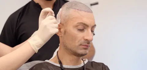 Man in Turkey during post-op check after hair transplant, doctor inspecting scalp for healing and graft placement.