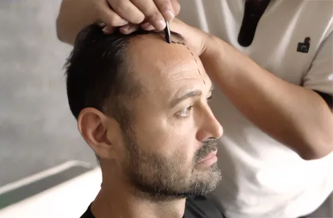Haartransplantation Türkei