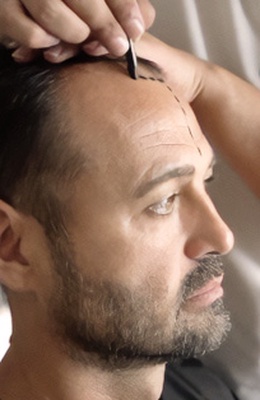 Hair transplant pre operation exam