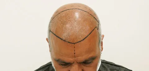 Man in Turkey before hair transplant showing pre-op scalp markings, planning hairline and graft areas for restoration.