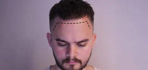 Man with marked hairline before hairline lowering surgery in Turkey, planning for balanced forehead shape