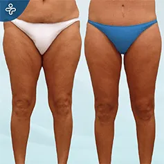 inner-thigh-lift-(1)