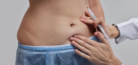 Doctor marking abdominal fat pocket before laser lipolysis (laser liposuction) body-contouring procedure