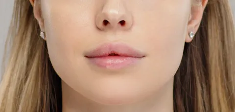Close-up of a woman’s lips after lip augmentation in Turkey, showing enhanced volume and symmetry
