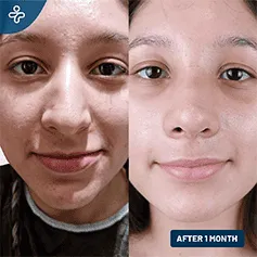 liquid-rhinoplasty