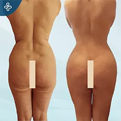 lower-body-lift-3