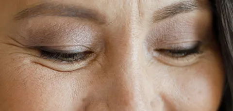 Close-up of eyes with visible under-eye bags before lower eyelid blepharoplasty in Turkey