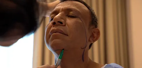 Doctor drawing pre-op markings on male patients neck for neck lift surgery