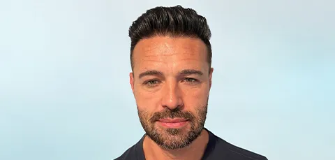 Man with receding hairline showing signs of male pattern hair loss, also known as androgenic alopecia