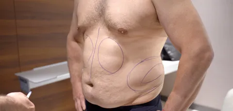 Male patient with surgical markings on abdomen before tummy tuck procedure