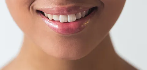 Close-up of a bright, harmonious smile after a successful maxillary osteotomy procedure (upper jaw surgery)