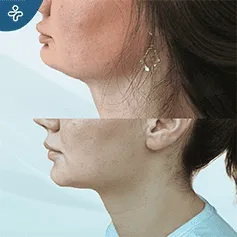 mentoplasty-(1)