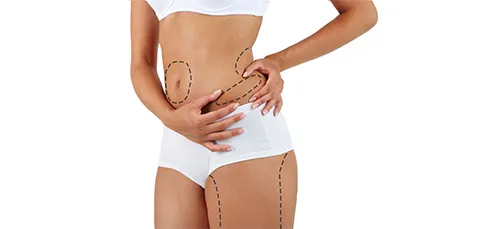 Woman in white shorts with dotted lines marking stubborn fat pockets—visualizing micro liposuction (microlipo) treatment zones