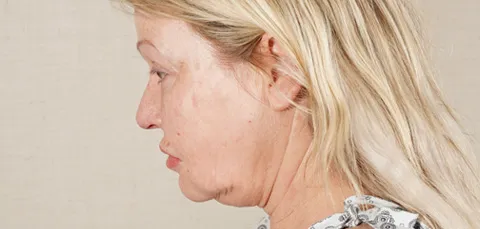 Profile view of woman before neck rejuvenation in Turkey showing sagging skin and excess fat under chin.