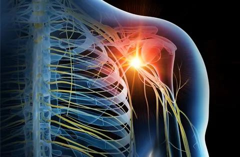 Neurolyse pour la douleur chronique : ce que permet l’intervention
