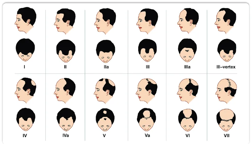 norwood hamilton scale