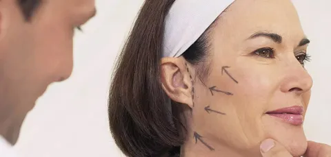Doctor marking cheek lift vectors during consultation for one stitch micro facelift facial rejuvenation procedure