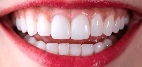 Close-up of white, symmetrical teeth after cosmetic dental treatments in Turkey
