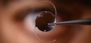 Close-up of an intraocular lens held by forceps before implantation during phacoemulsification cataract surgery.
