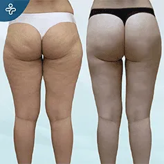 posterior-thigh-lift-(1)