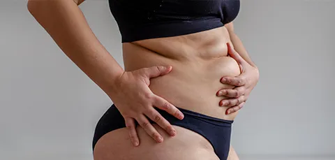 Side view of woman showing excess skin bulges illustrating ‘dog ears’ complication after tummy-tuck surgery