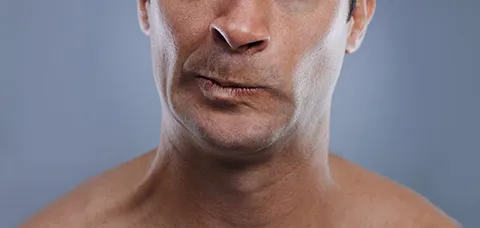 Adult man with asymmetrical mouth and facial weakness. visual example for Ramsay Hunt Syndrome vs. Bell’s palsy article.