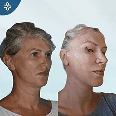 revision-facelift-surgery-3-(1)