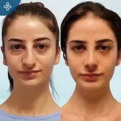 Aquiline Nose Nose job Before and After