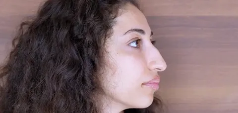 Side view of female rhinoplasty patient showing nasal bridge before surgery