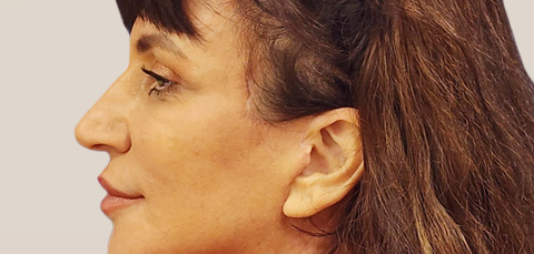 Scarless Facelift: Minimally Invasive Plastic Surgery for a Youthful Appearance