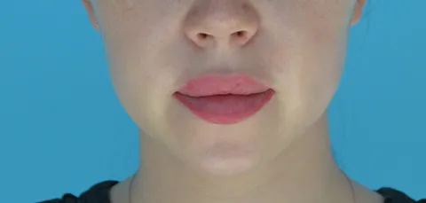Close-up of the lower face and mouth, illustrating the area enhanced by jaw augmentation.