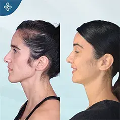 Elegant Lift with Temporal Lift Procedure