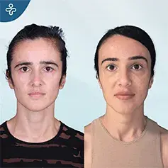Elegant Lift with Temporal Lift Procedure