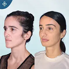 Elegant Lift with Temporal Lift Procedure