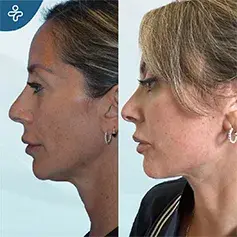 2-Month Temporal Lift with Face & Neck Lift
