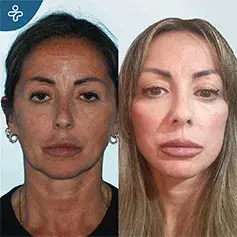2-Month Temporal Lift with Face & Neck Lift