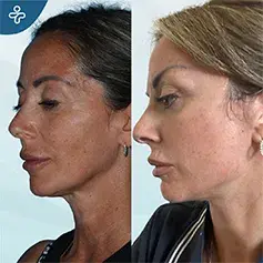 2-Month Temporal Lift with Face & Neck Lift